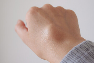 Female right back hand with ganglion cyst on the dorsum,  fluid-filled bump associated with a joint or tendon sheath, close-up view, selected focus.