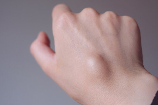 Female right back hand with ganglion cyst on the dorsum,  fluid-filled bump associated with a joint or tendon sheath, close-up view, selected focus.
