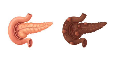 Healthy versus diseased pancreas comparison; anatomical illustration showing healthy and inflamed pancreatic tissue.