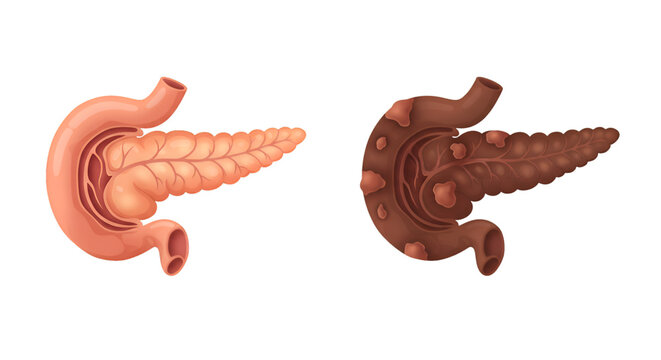 Healthy versus diseased pancreas comparison; anatomical illustration showing healthy and inflamed pancreatic tissue.