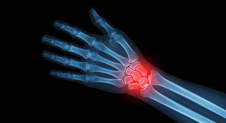 Blue Hand X-Ray Highlighting Wrist Pain on Black Background for Medical Illustration
