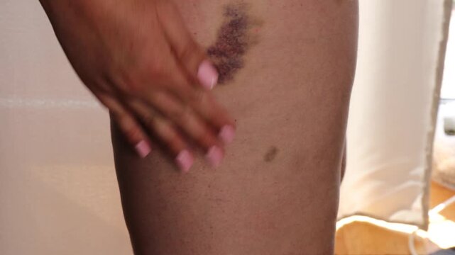 multiple large bruises on human leg closeup under daylight possible blood clotting disorder medical symptom concept of health monitoring and diagnostics