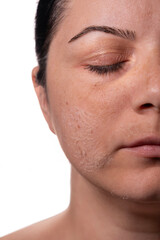 Woman peeling facial skin – Skincare treatment concept – Female face with flaky skin after exfoliation