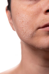 Obraz premium Woman peeling facial skin – Skincare treatment concept – Female face with flaky skin after exfoliation