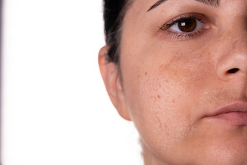 Woman peeling facial skin &ndash; Skincare treatment concept &ndash; Female face with flaky skin after exfoliation