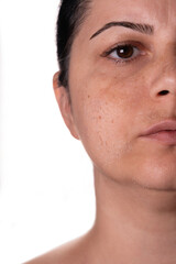 Fototapeta premium Woman peeling facial skin – Skincare treatment concept – Female face with flaky skin after exfoliation
