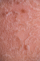 Fototapeta premium Skin shedding and regeneration close-up – Dermatology concept – Peeling human skin