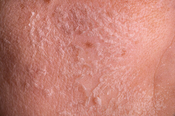 Fototapeta premium Skin shedding and regeneration close-up – Dermatology concept – Peeling human skin