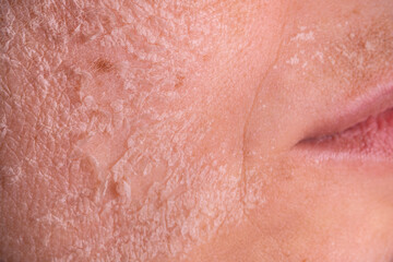 Fototapeta premium Skin shedding and regeneration close-up – Dermatology concept – Peeling human skin
