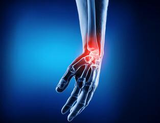 schmerzendes, Handgelenk - 1