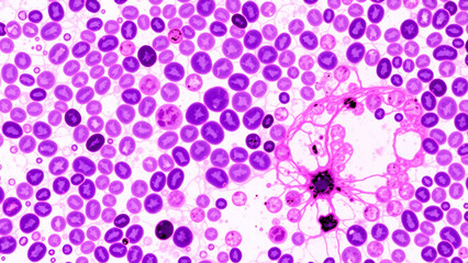 Histopathology of bacterial abscess, neutrophil infiltration (multi-lobed nuclei), central necrosis with ghost cells.