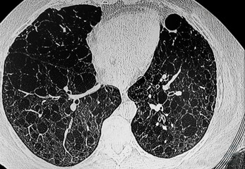 Medical themes: CAT- Scan of Lynphangiomatosis in a young female.