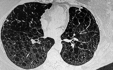 Medical themes: CAT- Scan of Lynphangiomatosis in a young female.