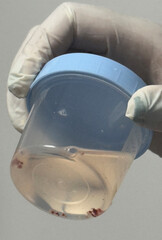 Medical themes: Bronchoscopy showing transbronchial biopsies