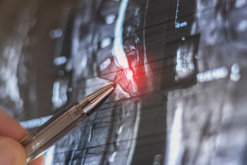 Doctor learning MRI of the lumbar spine.  At level 12, an arachnoid cyst measuring 13x14 mm is...