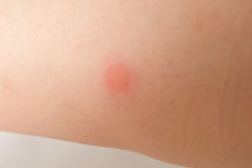 mosquito bite mark on Japanese woman arm