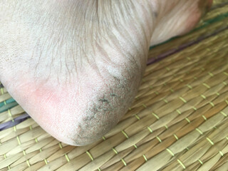 Cracked heels in asia woman on mat. Close-up dry skin and dirty   that need to treatment.