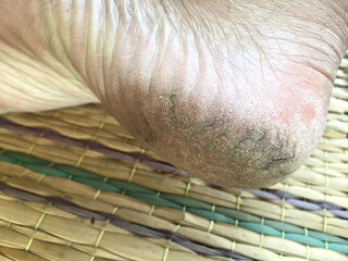 Cracked heels in asia woman on mat. Close-up dry skin and dirty   that need to treatment.