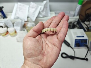 metal-ceramic artificial dentures in the hands