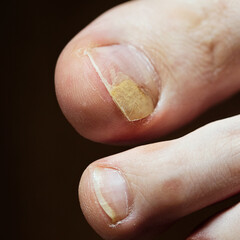 Onycholysis on big toe nail showing detachment and discoloration associated with nail trauma, poor...