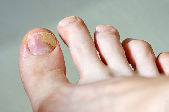 Onycholysis affecting big toe showing toenail detachment from the nail bed indicating possible trauma or fungal infection requiring footcare. Macro shot, selective focus