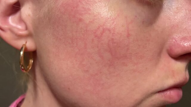 Macro close-up of woman&rsquo;s cheek with visible broken capillaries, facial redness, rosacea and texture. Dermatology concept, natural condition, untreated skin.
