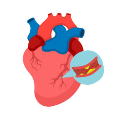 Coronary artery disease vector illustration on white background