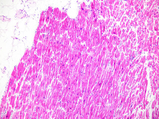 Left ventricular hypertrophy is seen in diseases such as hypertension. Histopathological changes include myocardial hypertrophy, disordered arrangement and fibrous hyperplasia.Magnify 100x.
