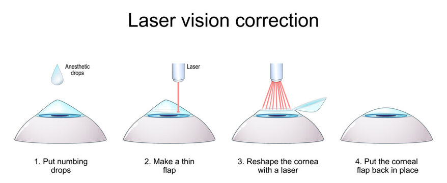 Steps of Laser vision correction. LASIK