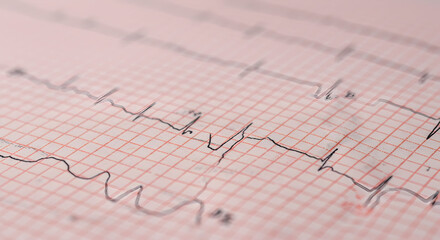 Detailed Electrocardiogram Analysis Chart Showing Cardiac Health Monitoring Data with Graphical Patterns and Measurements