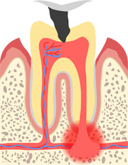 Tooth abscess 
