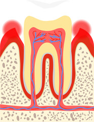 Fototapeta premium Gingivitis 