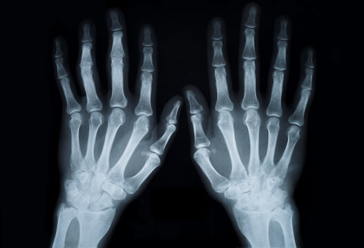 X-ray hands, front view. Medical examination, x-ray for medical diagnosis 