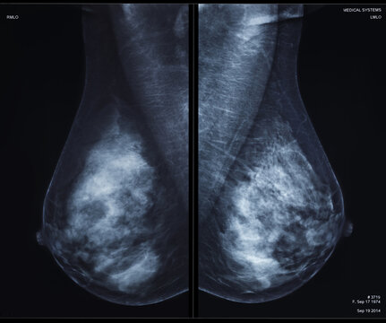 X-ray mammography cancer, checking breasts. Mammogram both breast, mlo view,  breast scan.