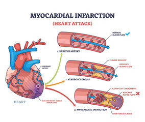 Myocardial infarction shows a heart with arteries, plaque buildup, and blood clot, illustrating heart attack causes. Outline diagram