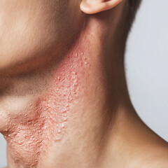 Neck with red irritated eczema flare-up on male skin

