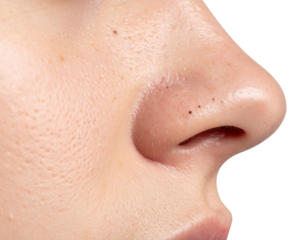 Close-up image of a human nose and cheek showing skin texture, pores, and fine facial hair against a black background.