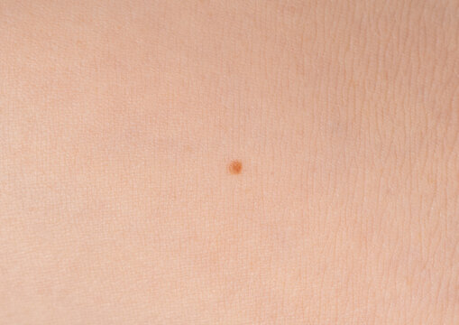 Skin mole spot closeup. Human birthmark, nevus macro texture