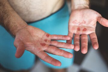 Man's hand with callus wound.