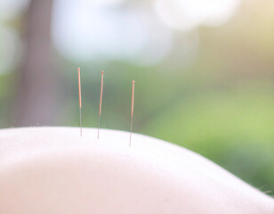 Acupuncture session closeup wellness center image serene environment macro view healing concept