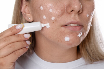 Woman applying cream onto face on white background, closeup. Acne treatment