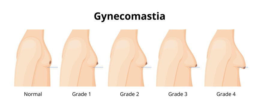 Gynecomastia Stages Showing Different Breast Sizes