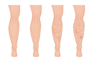 Stages of varicose veins developing on human leg