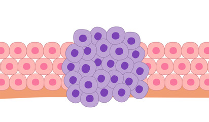 Cancer cells with normal cells on a white background.