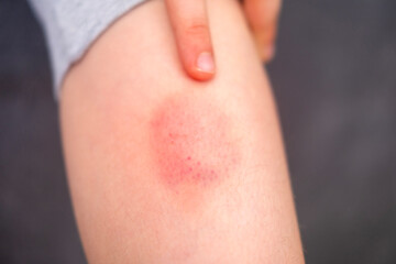 Fototapeta premium little boy holds sore leg, human skin with large red and prominent purple bruise, showing discoloration from injury, Medical condition, childhood safety