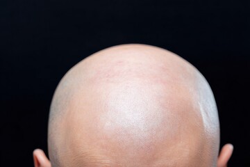 Close up view of smooth, hairless head against dark background, showcasing texture and shine of scalp. image evokes sense of clarity and simplicity