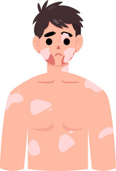 Fototapeta premium Vitiligo 