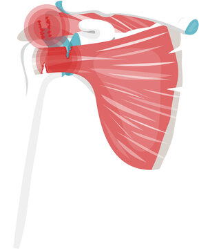 rotator cuff tear