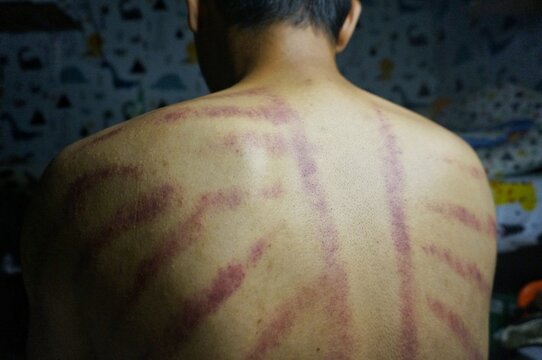 Red scars from scratches on a man's back. Scraping is a traditional treatment for cold symptoms in Javanese Indonesian culture.