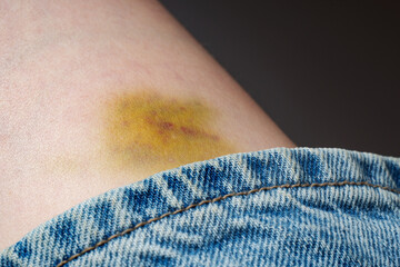 Bruise on the leg - healing hematoma.
